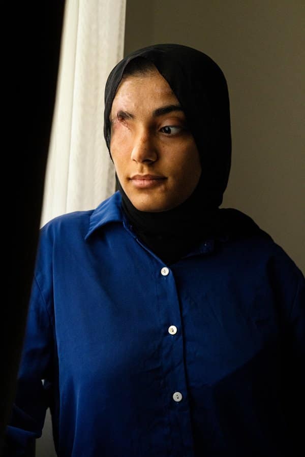 Ruba Abu Jibba lost an eye during shelling as her family was fleeing Israeli tanks in Gaza..
She and some other badly wounded Gazans survived a war that has killed tens of thousands. They made it out for medical treatment in Qatar. In Qatar, 6 Sept 2024